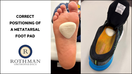 Correct Positioning of a Metatarsal Foot Pad