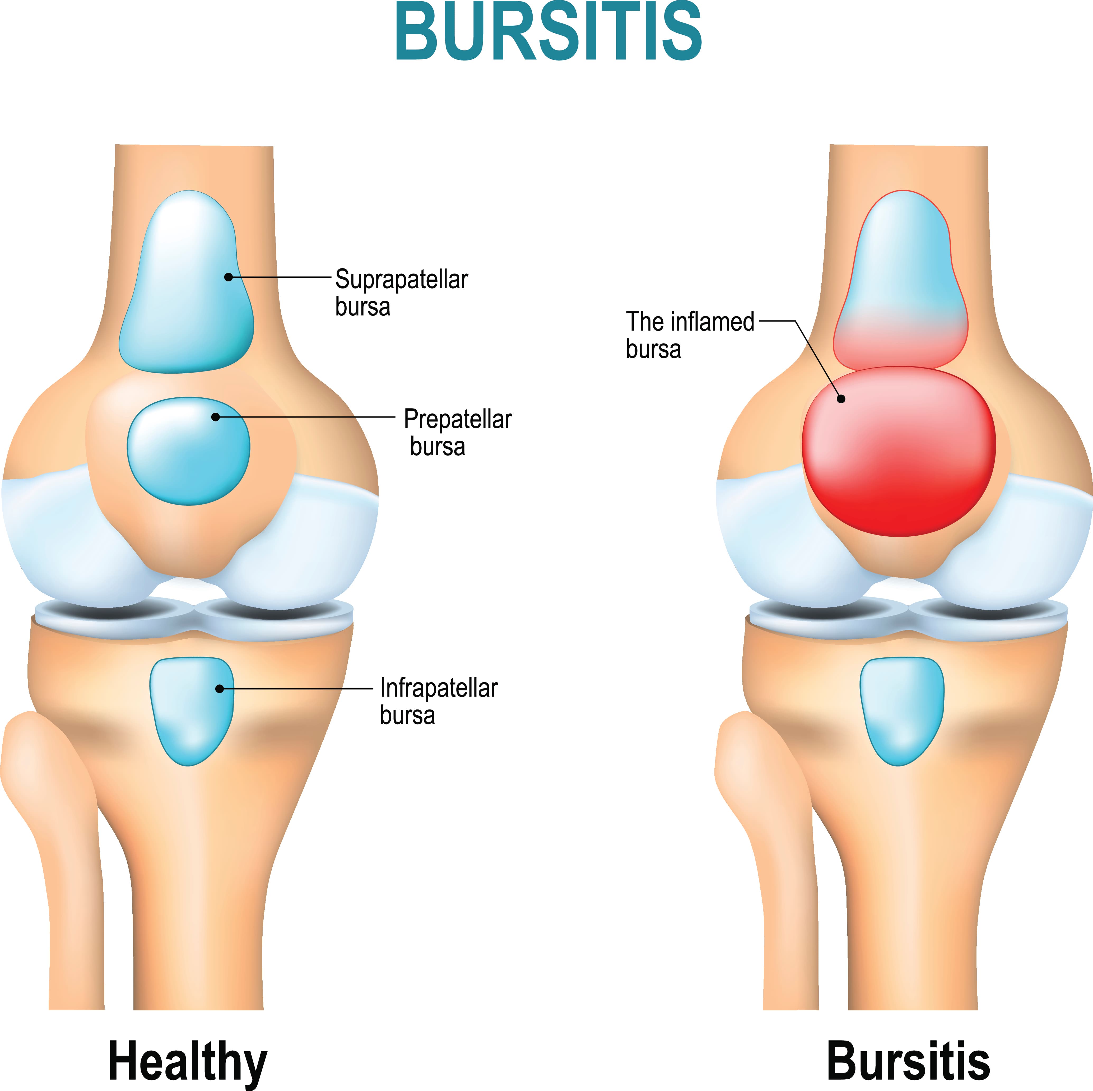 medical illustration of healthy knee versus knee with Bursitis