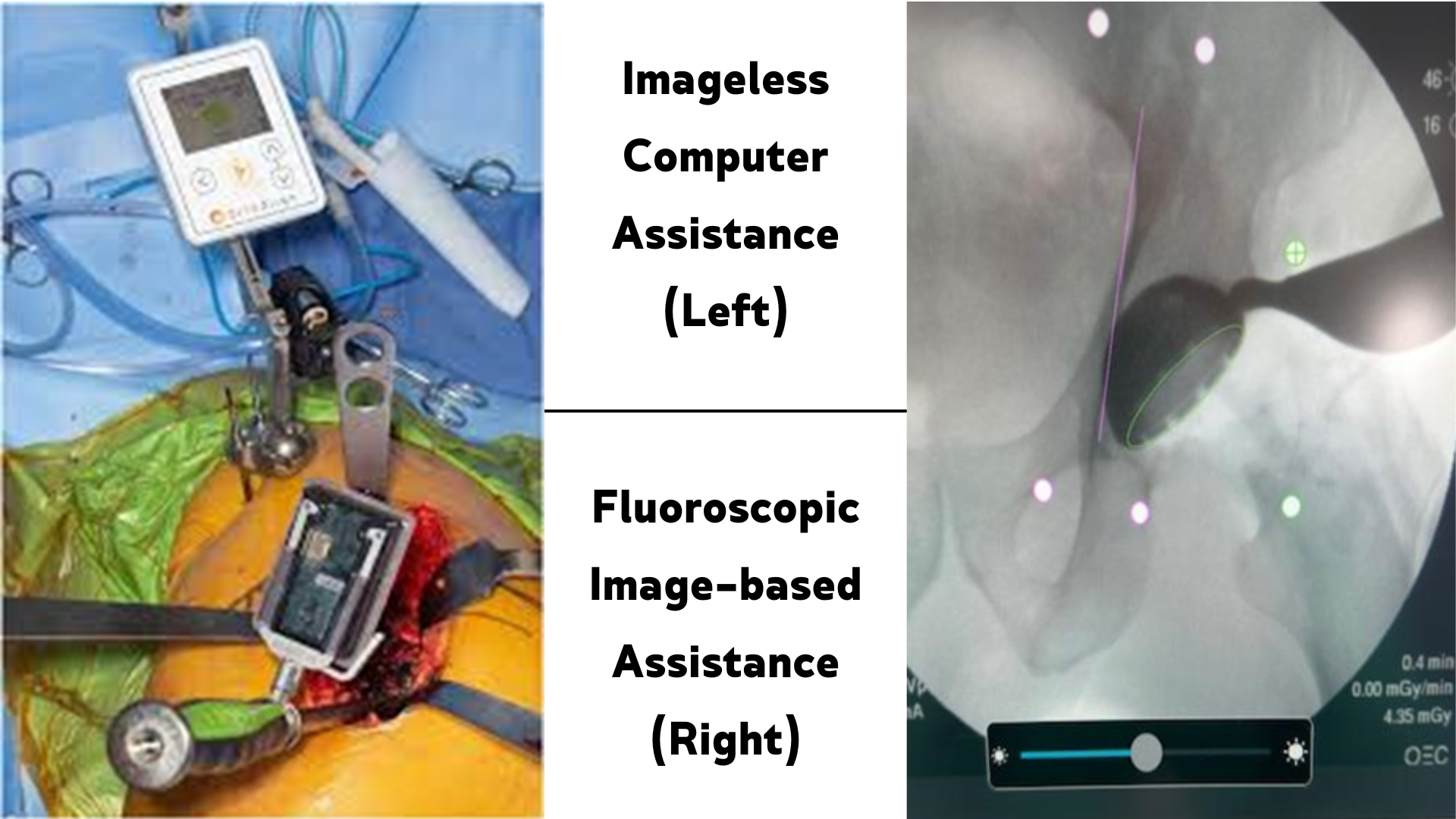 Imageless and Fluoroscopic Computer Assistance