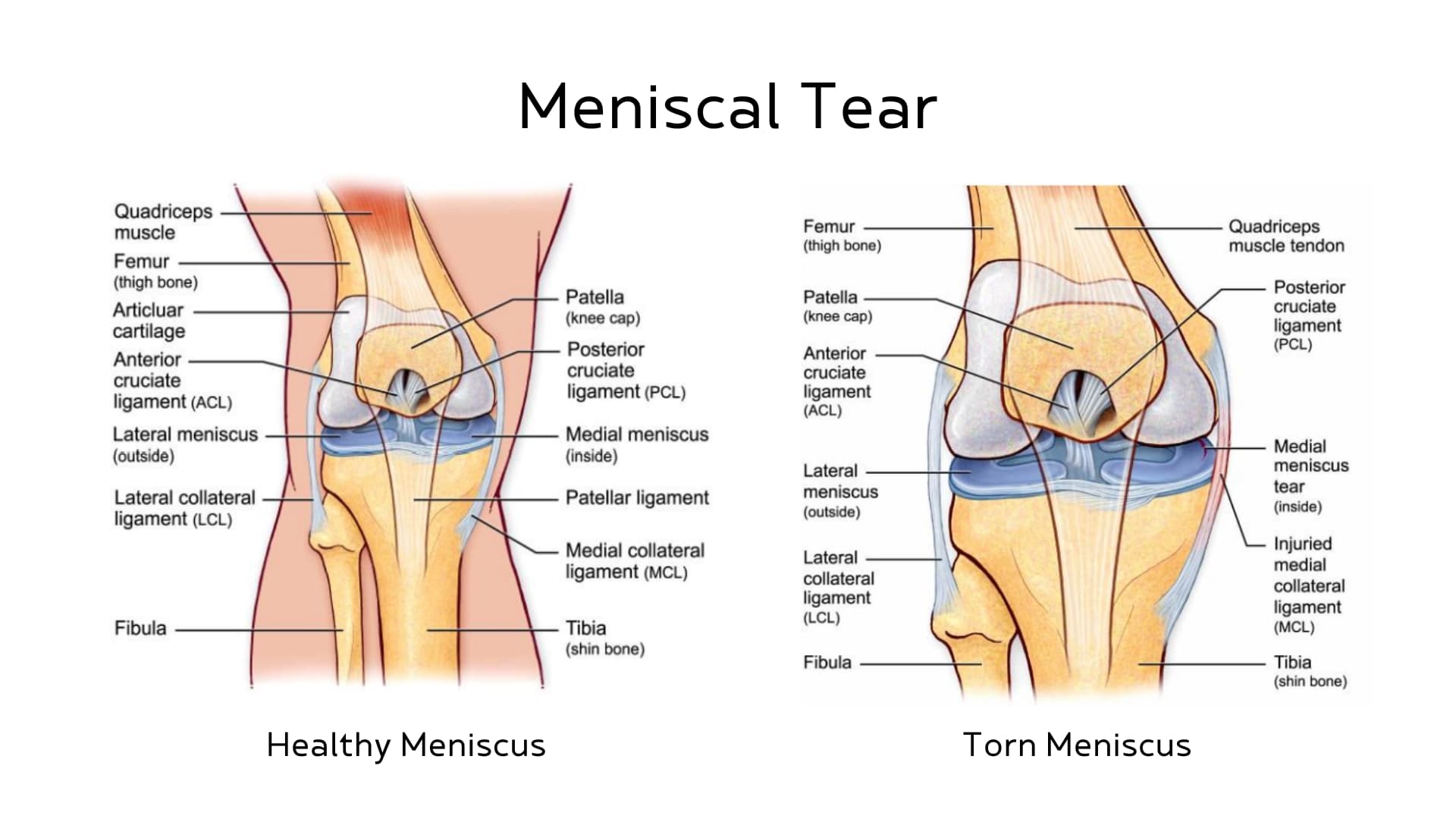 medical illustration of knee with Meniscal Tears