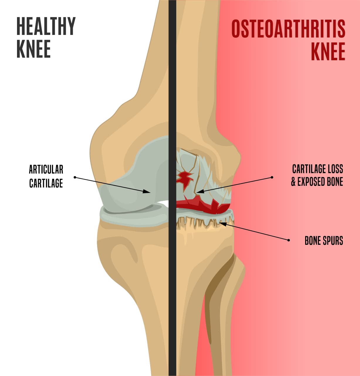 medical illustration of healthy knee versus knee with Osteoarthritis