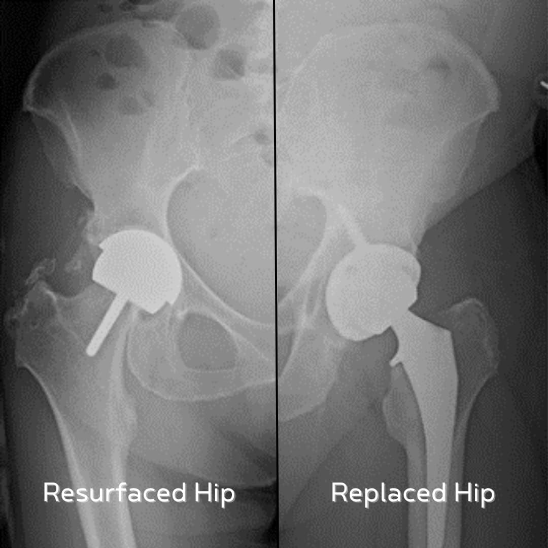 xray image of replaced hips vs resurfaced hips
