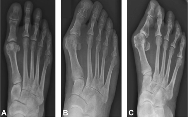 X ray of 3 feet, comparing bunions