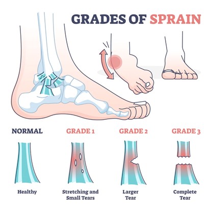 A diagram of a foot showing the different grades of ankle sprain including normal or healthy, grade 1 small tear, grade 2 large tear and grade 3 complete tear.