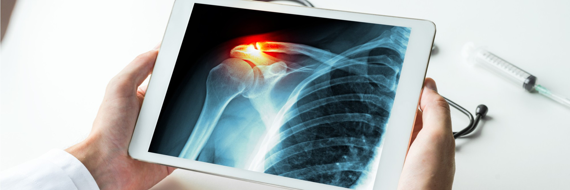 Acromioclavicular Joint Osteoarthritis Orlando, FL