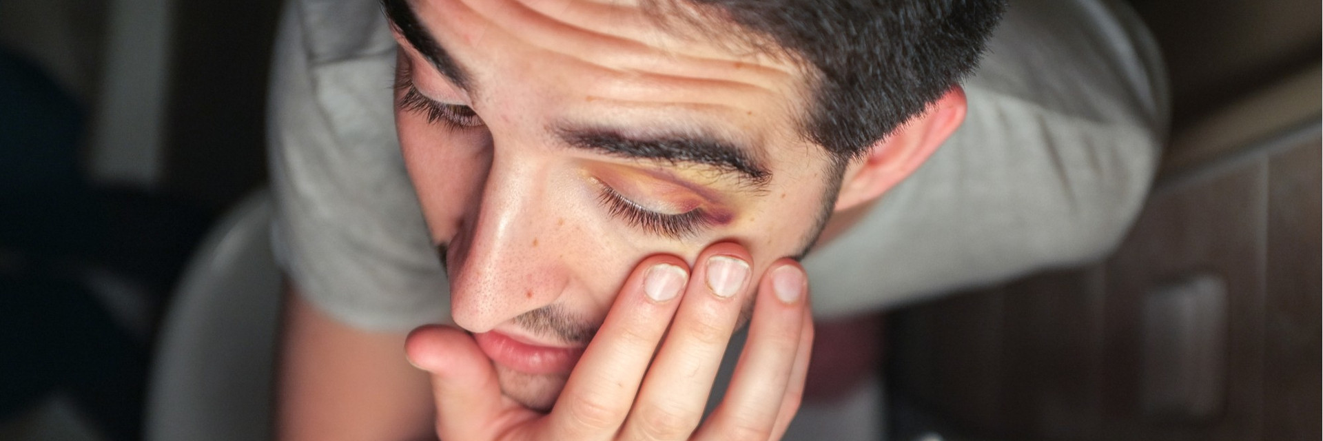 The Black Eye: Head or Face Contusion