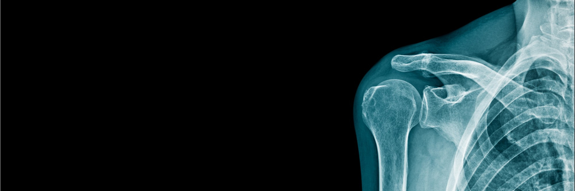 Shoulder Pain - Florida Ortho Care