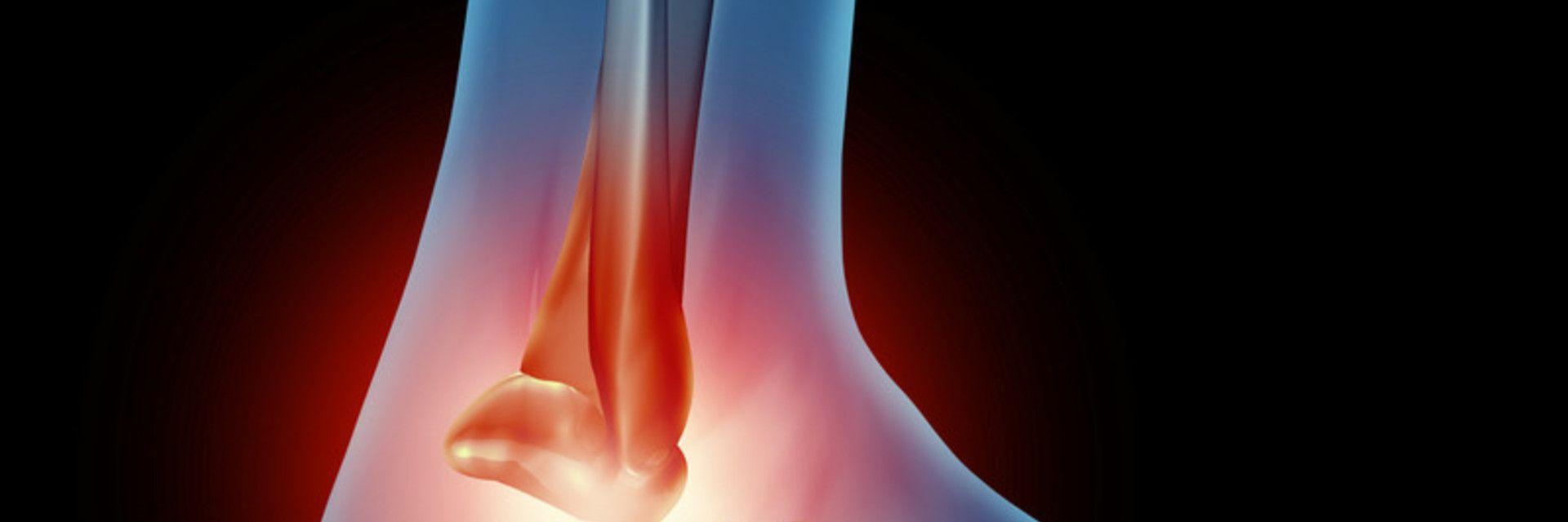 Fractured Ankle Symptoms  Florida Orthopaedic Institute