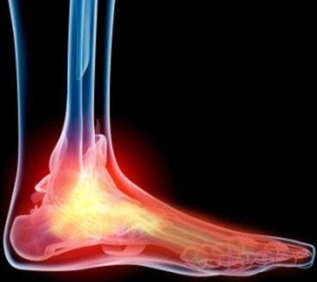 intermittent achilles pain