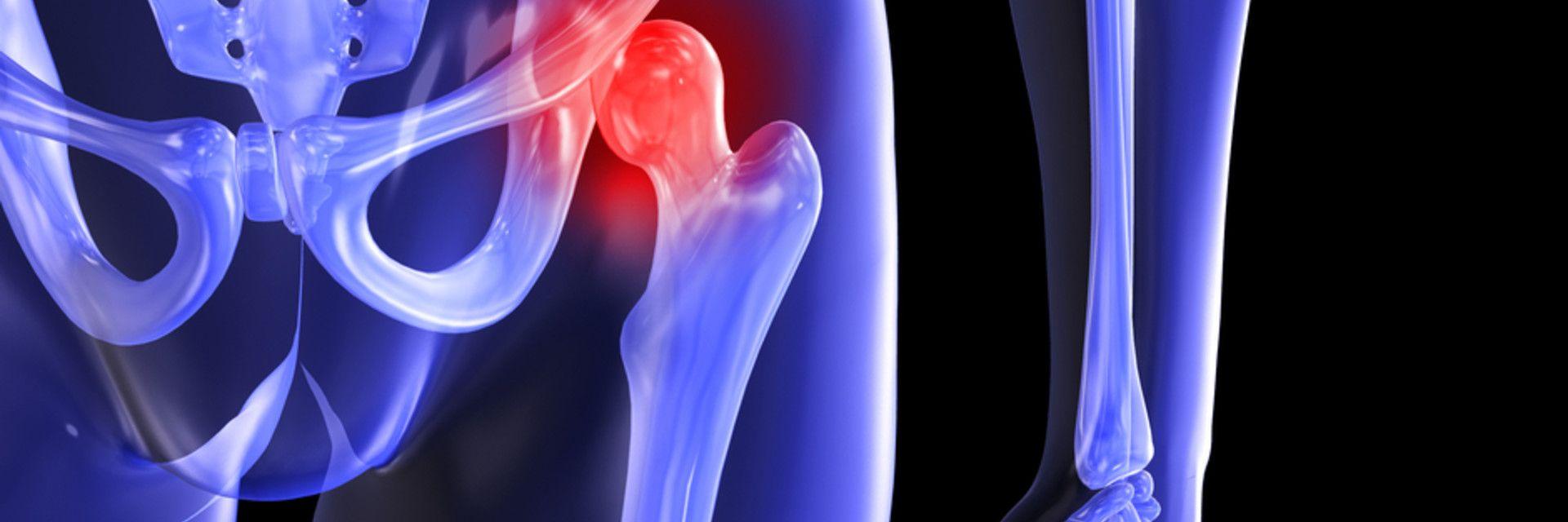 Identify & Address Symptoms of Hip Arthritis With These 3 Tips