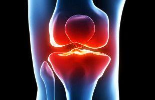 Three Common Culprits of an Arthritic Knee