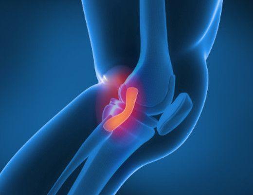 Medial Collateral Ligament (MCL) Tear Midtown East NY