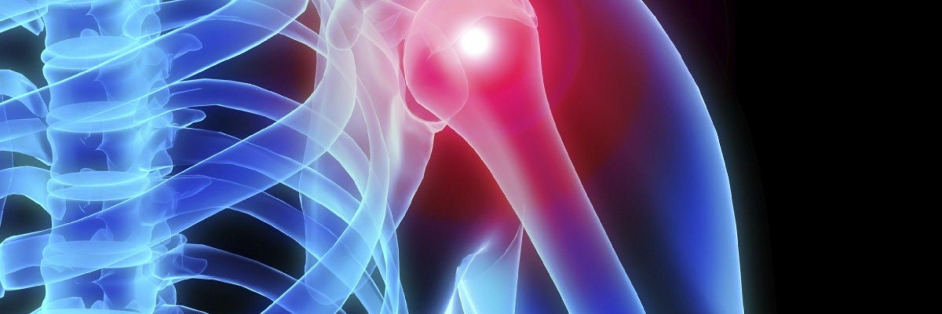 Acromioclavicular Joint Osteoarthritis Orlando, FL