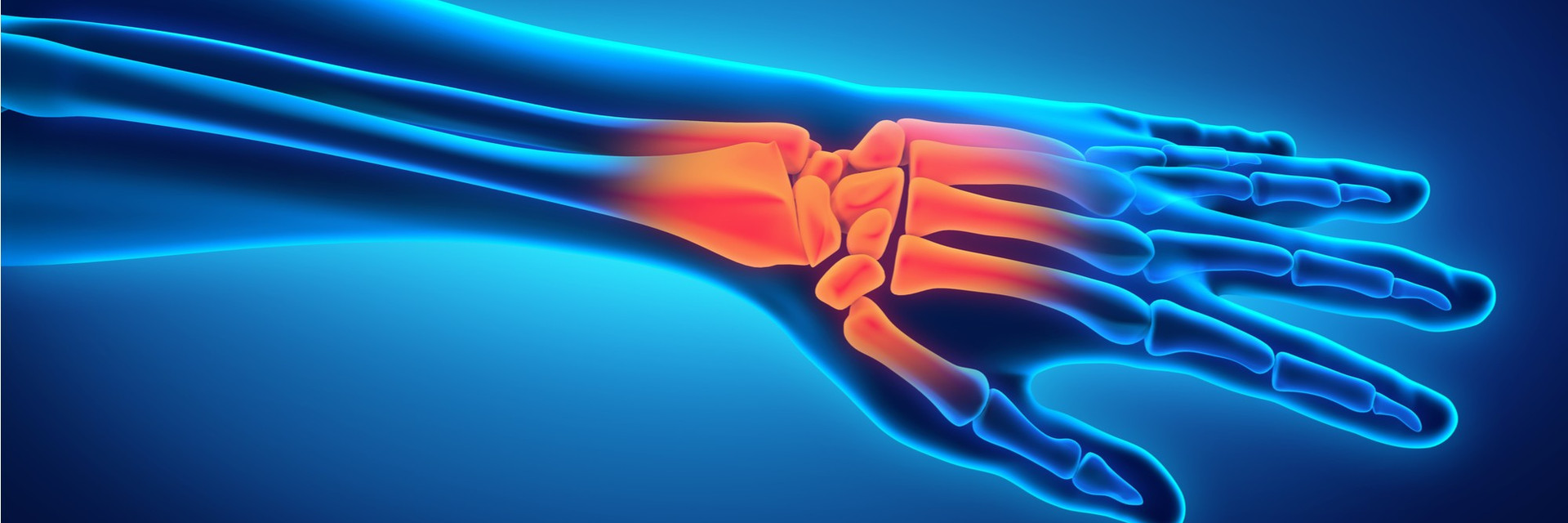 Physiotherapy in Hamilton downtown for Endoscopic Carpal Tunnel Release