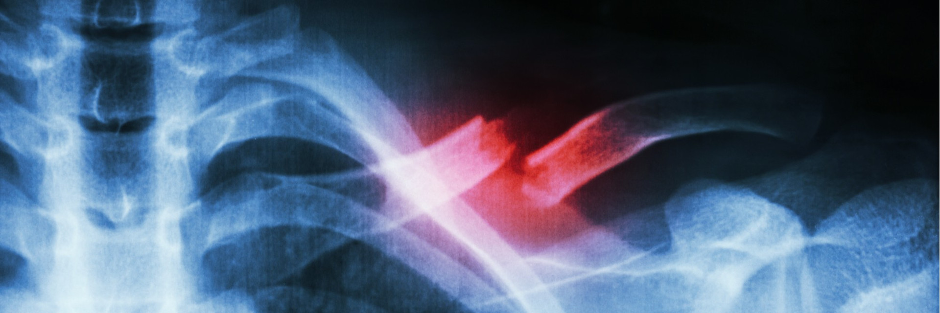 clavicle bone fracture