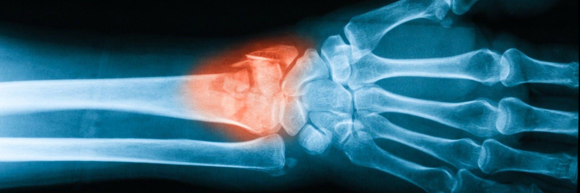 10 Facts To Know About Your Wrist Fracture Procedure | Rothman