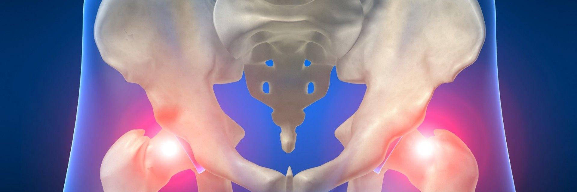 What Is Hip Osteoarthritis?