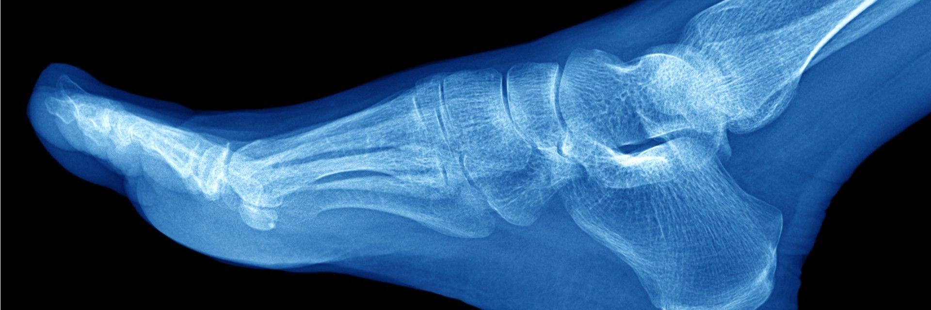 Physical Therapist's Guide to Ankle Fracture