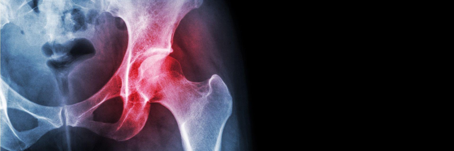 Everything You Need To Know About The Benefits Of Hip Preservation Surgery Rothman Orthopaedic 3499