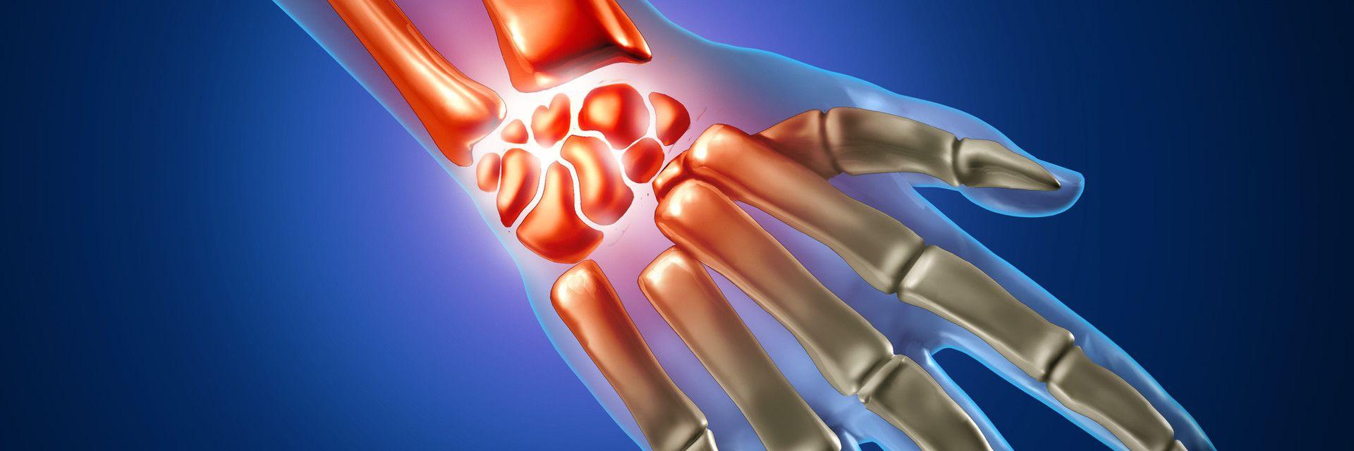 Carpal Tunnel Pain Treatment NJ & NYC