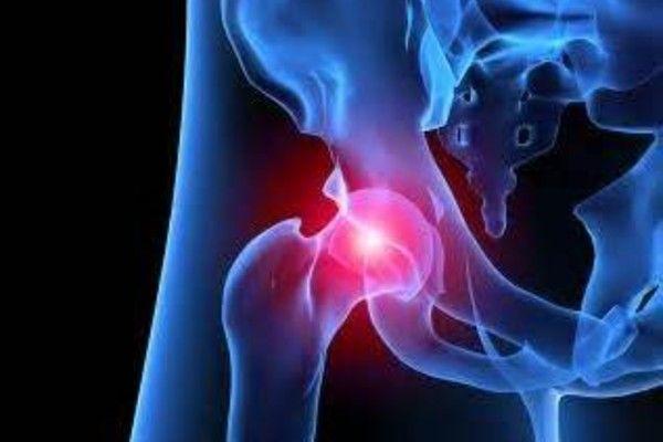 What You Need to Know About Total Hip Replacement Surgery