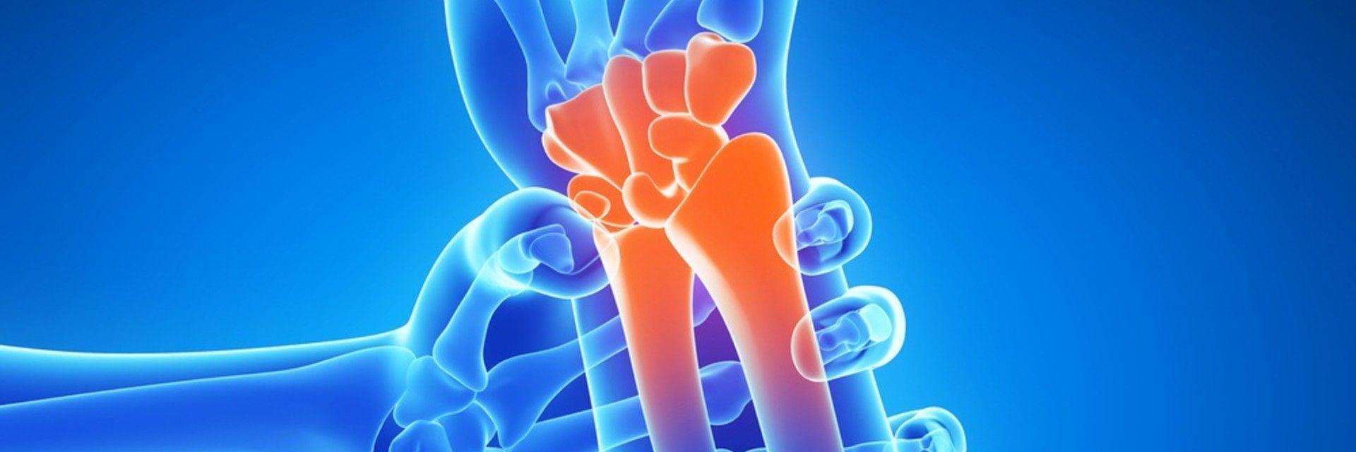 Healthy Bone Tips from Rothman Orthopaedic Institute’s Distal Radial Fracture Physicians