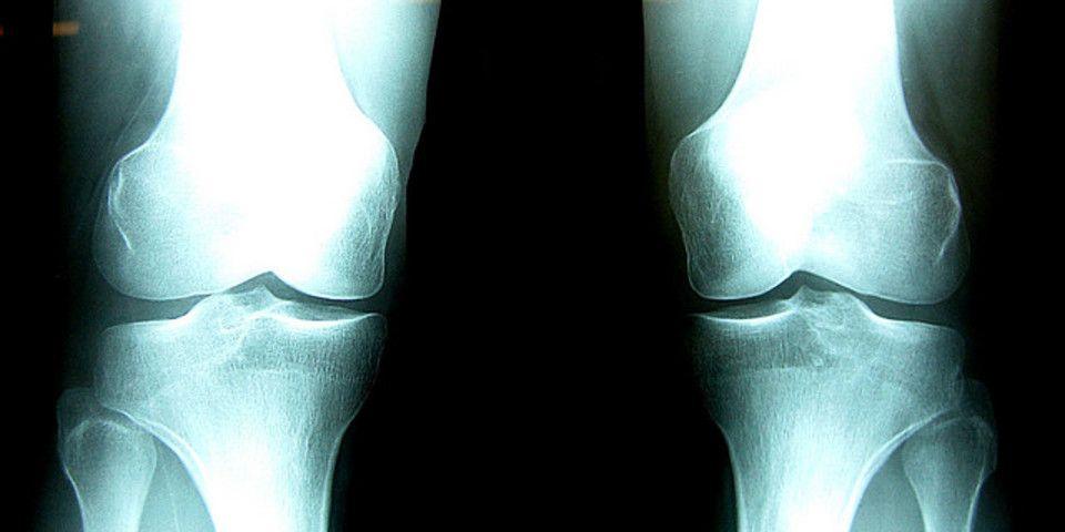 Funny knee xray - 🧡 Severe Knee Arthritis X Ray: GEORGE D. GOUDELIS MD. 