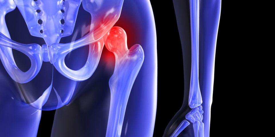 identify-address-symptoms-of-hip-arthritis-with-these-3-tips