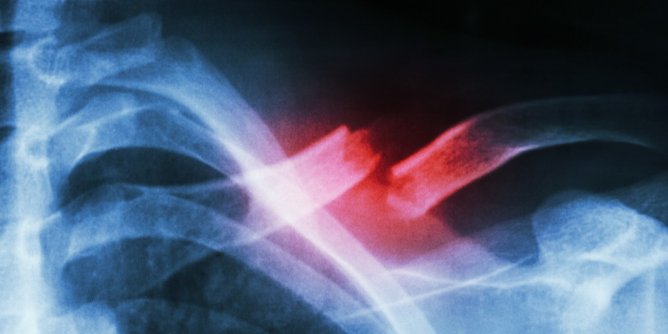 Mountain Bikers Broken Collarbone Treatment Rothman Orthopaedic