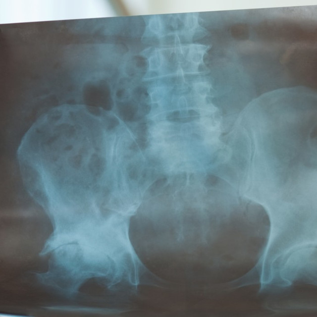 A Closer Look At Arthroscopic Hip Surgery Rothman Orthopaedic Institute